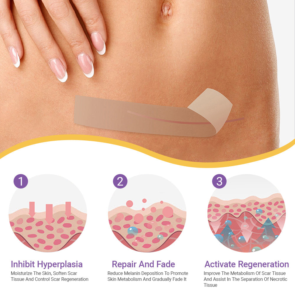 ✅Official Store |SEAGRIL® Hyaluronic Acid Nano Microneedle Repair Tape🏥(Treatment of old and new scars, reduction of surgical scars, stretch marks, keloids, acne, burns, warts, dermatomes and varicose veins)