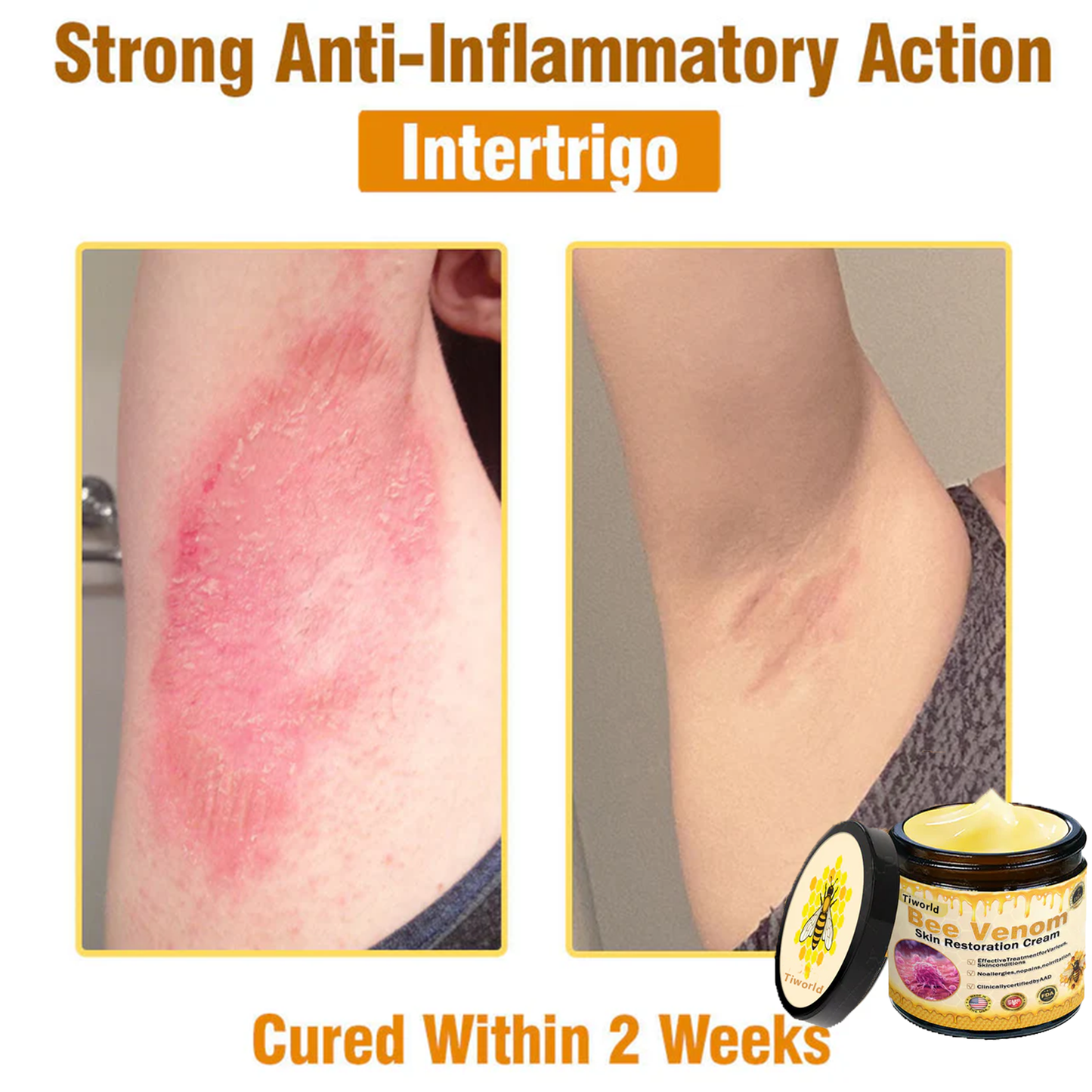🎁Tiworld™ Bee venom Comprehensive Cream — 🔥Limited Time 80% OFF🔥